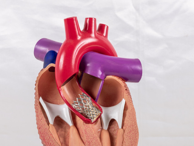 Modell einer katheter-gestützten Herzklappen-Prothese (TAVI) in der Aorta.